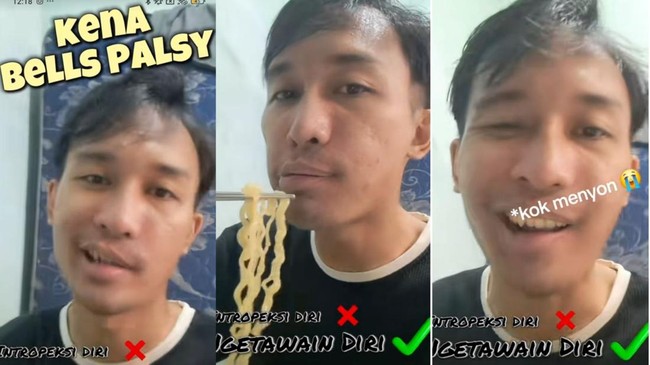  pria dengan bell's palsy menunjukkan mulut miring saat makan mi instan
